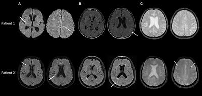 Cerebral Amyloid Angiopathy Related Inflammation With Prominent Meningeal Involvement. A Report of 2 Cases